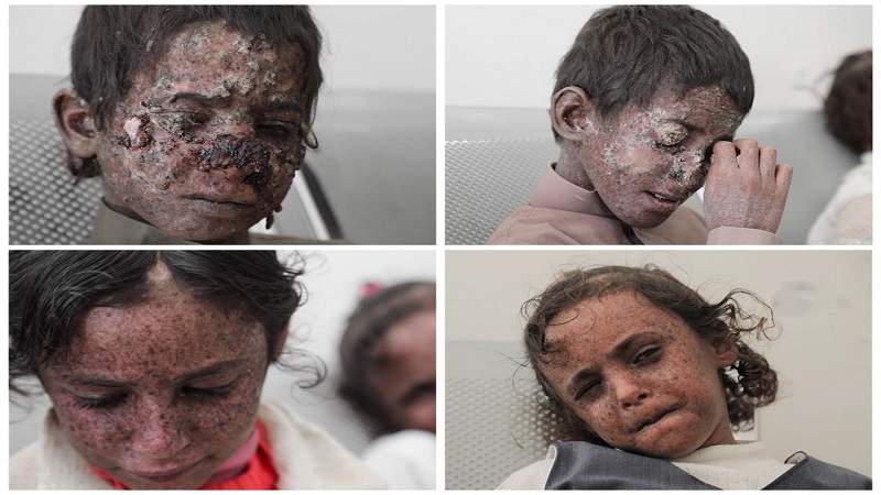 4 enfants yéménites atteints du cancer de la peau suite aux missiles saoudiens largués contre leur village.